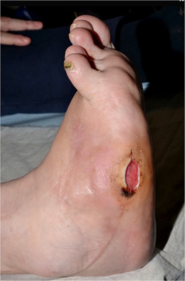 Clinical photo demonstrating infected ulcer to lateral boarder of right foot.