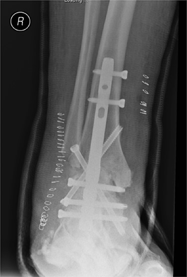 Anterior–posterior radiograph of right ankle demonstrating tibiotalocalcaneal fusion using a hindfoot nail and screws.