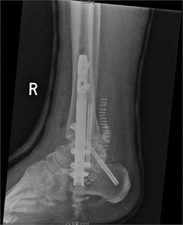 Lateral radiograph of right ankle demonstrating tibiotalocalcaneal fusion using a hindfoot nail and screws.