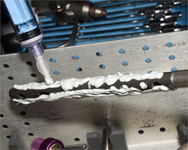 Clinical photo demonstrating syringe application of Cerament-V to hindfoot nail.