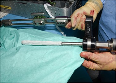 Clinical photo demonstrating Cerament mantel around hindfoot nail.