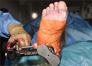 Clinical photo demonstrating hindfoot nail attached to jig, positioned in hindfoot and the citing of locking screws.