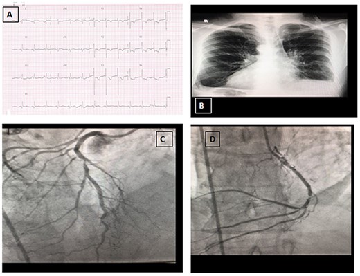 A: Electrocardiogram (ECG) on presentation. B: Chest radiograph showing dextrocardia. C: Coronary angiography view of left anterior descending artery (right sided). D: Coronary angiography view of circumflex artery (right sided).