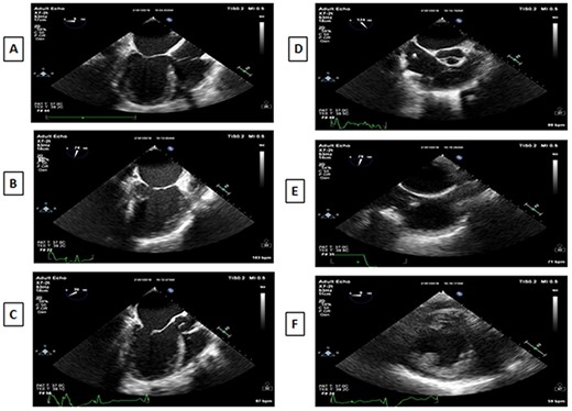 A: Midesophageal four-chamber view at 0°. B: Midesophageal two-chamber view at 90°. C: Midesophageal aortic valve LAX at 30°. D: Midesophageal aortic valve SAX at 120°. E: Midesophageal bicaval view. F: Transgastric midpapillary short axis view at 0°.