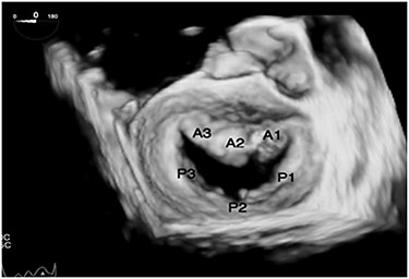Transesophageal echo 3D view of mitral valve in dextrocardia as viewed intraoperatively by the surgeon standing on the left side of the patient.