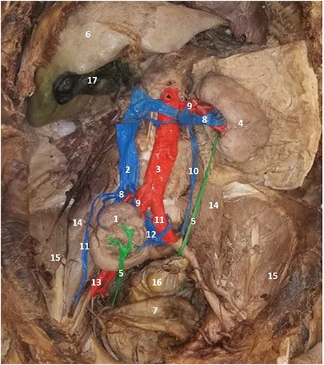 Posterior abdominal wall and pelvis. 1. Right (Pelvic) kidney, 2. inferior vena cava, 3. thoracic aorta, 4. left kidney, 5. ureter, 6. liver, 7. urinary bladder, 8. renal vein, 9. renal artery, 10. gonadal vein, 11. common iliac artery, 12. common iliac vein, 13. external iliac artery, 14. psoas major, 15. iliacus, 16. rectum, 17. gall bladder.