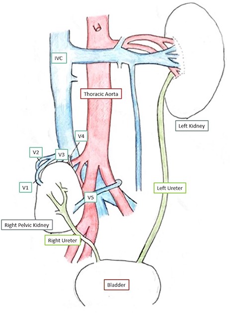 Schematic diagram of kidneys and vasculature. V1–V5—renal veins.