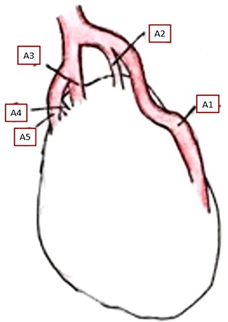 Posterior aspect of the pelvic kidney showing its arterial supply. A1–A5—renal arteries.