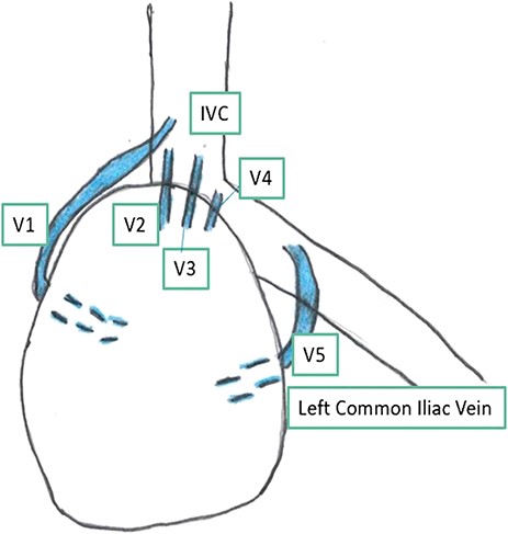 Posterior aspect of the pelvic kidney showing its venous drainage. V1–V5—renal veins.
