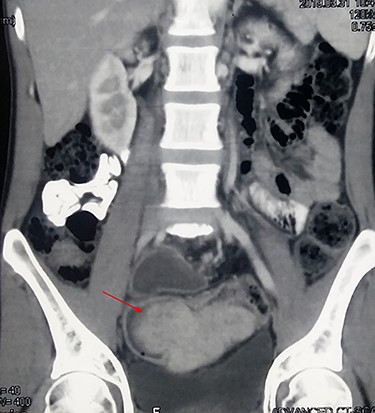 Contrast CT showing a large, enhancing, intraluminal soft tissue tumor (arrow) in the sigmoid colon.