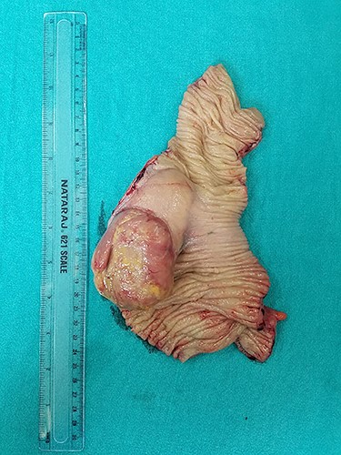 Intraoperative (cut-open) specimen showing smooth, well-defined protruding intraluminal tumor with intact mucosa.