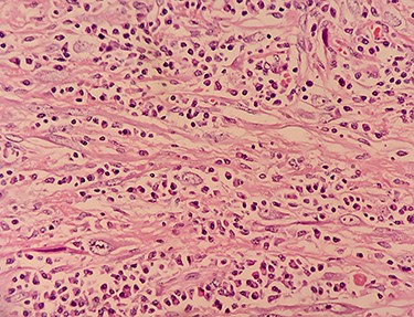 Photomicrograph (high power view; ·400) showing admixture of plasma cells, lymphocytes and spindle-shaped cells.