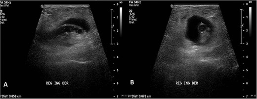 (A) Longitudinal ultrasound of the groin area showing a well-defined cystic mass with a central tubular image that terminated in a blind-ended tip. (B) Cross-sectional ultrasound showing the appendix more than 6 mm in diameter with echogenic surrounding fat soft tissue suggesting inflammatory changes.