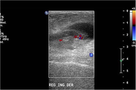 Doppler ultrasound with increased flow on the tip of the appendix.