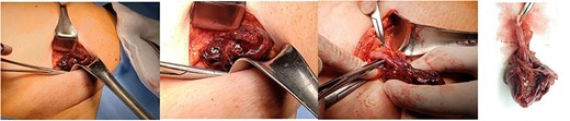Cross-sectional incision and dissection of superficial planes; inguinal canal with ordinary content is explored; appendix with gangrenous characteristics within the hernial content. Intestinal resection is performed with appendectomy.