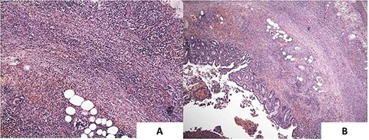 (A) Inflammation extends into the lamina propria. H&E ×100. Large collections of neutrophils are also seen in the lumen and in the muscle layer. (B) The inflammatory infiltrate is predominantly neutrophilic. H&E ×40.