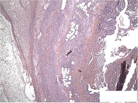 The sections show the appendiceal wall from mucosa to serosa with transmural inflammation. Focal mucosal ulceration is seen as well as congested vessels. Crypt architecture is preserved. H&E ×40.