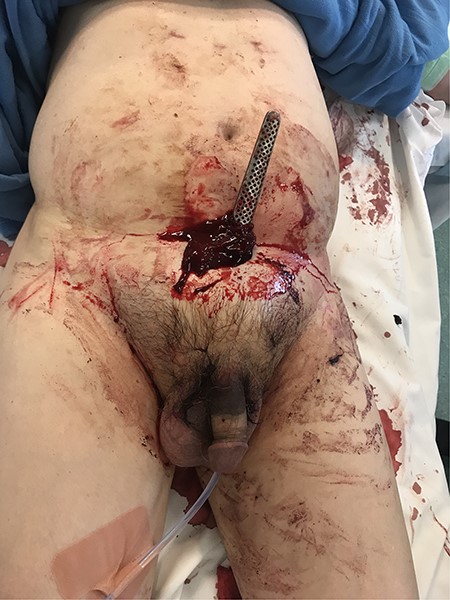 Photograph of the stab wound displaying the infero-posteriorly directed knife and surrounding haematoma of the mons pubis. Bruising can be seen extending to the penis.