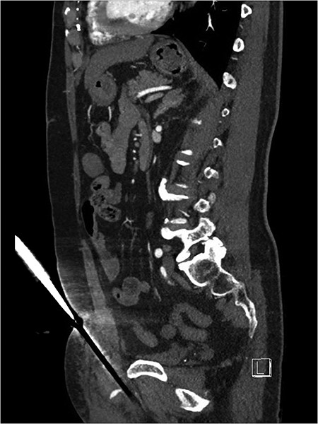 Suprapubic stab wound: sagittal section: CT mesenteric angiogram showing knife directed in infero-posterior direction abutting but not traversing the peritoneum. Active arterial contrast extravasation can be seen. The tip of the knife abuts the root of the penis.