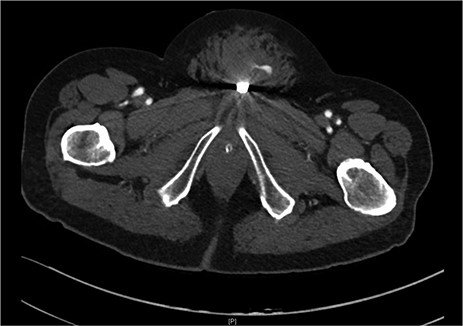 Suprapubic stab wound: coronal section: CT mesenteric angiogram showing mons pubis haematoma with active arterial extravasation.