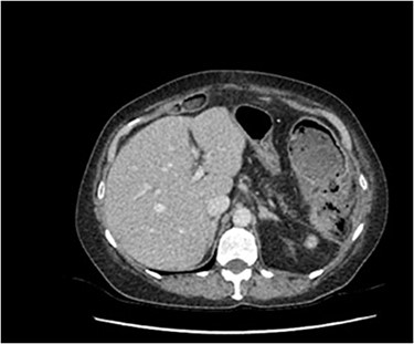 Significant inflammatory change surrounding an irregular appearing splenic flexure with the impression of a likely contained perforation in this region.
