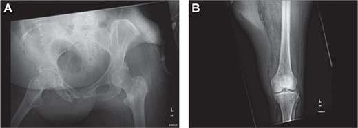 X-ray of (a) pelvis and (b) left lower limb demonstrated obvious air in soft tissue compartment in right gluteal and left thigh.