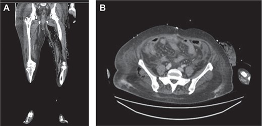 (a) Air in the deep medial and posterior compartments of the thighs and calf suggestive of residual infection in the deep compartment. (b) New finding of air in the right gluteus medius muscle.