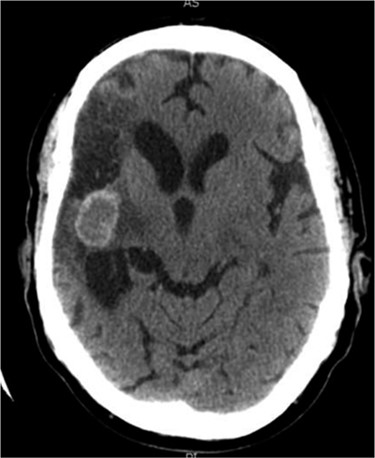 Axial CT head (2005) demonstrating hyper-dense cystic abnormality in the right external capsule.