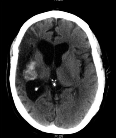 Axial CT head (2007) demonstrating hyper-dense cystic abnormality in the right external capsule.