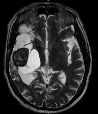 Axial MRI head (2012) demonstrating 4 × 4 cm solid mass with surrounding fluid enhancement.