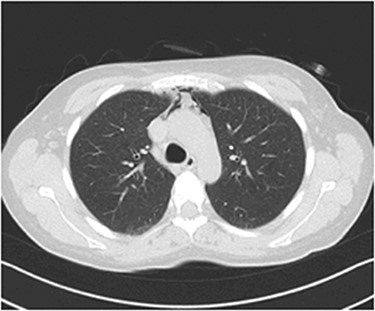 CTPA images show the presence of gas in the upper anterior mediastinum.