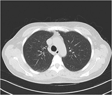 Thorax CT during the fourth postoperative day: a significant reduction of the mediastinal gas collection is observed.