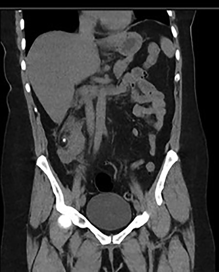 Coronal and transverse CT showing a malrotated right kidney with a non-obstructive calculus and marked perinephric stranding. This ectopic kidney also has an abnormal axis, facing anterolaterally.