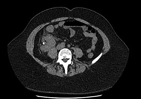 Coronal and transverse CT showing a malrotated right kidney with a non-obstructive calculus and marked perinephric stranding. This ectopic kidney also has an abnormal axis, facing anterolaterally.