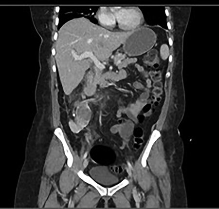 Progress CT showed worsening of perinephric inflammatory stranding and low-density area at the interpolar and upper pole of the right kidney representing an early renal abscess.
