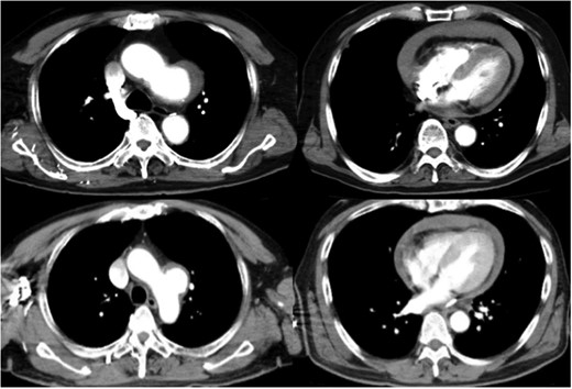Preoperative computed tomography shows a distal arch aneurysm and pericardial effusion (top: Case 1; bottom: Case 2).