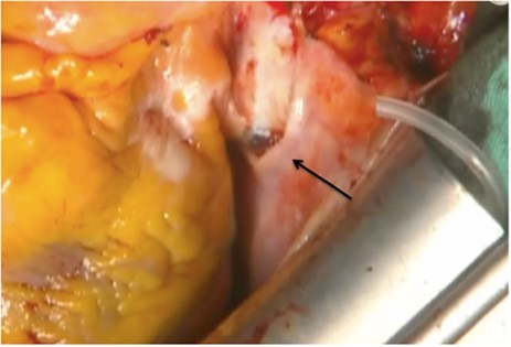 The foramen lacerum at the aneurysm that penetrates the pericardium (arrow).