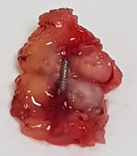 Intraoperative magnetometric identification of marked lymph node.