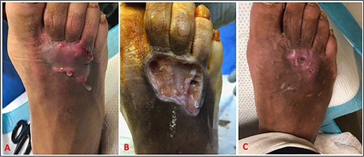 (A) HS on dorsum of the right foot. (B) HS lesion excised to the subcutaneous tissue. Immediate split-thickness skin graft (not shown). (C) Near complete wound healing by postoperative day 17.