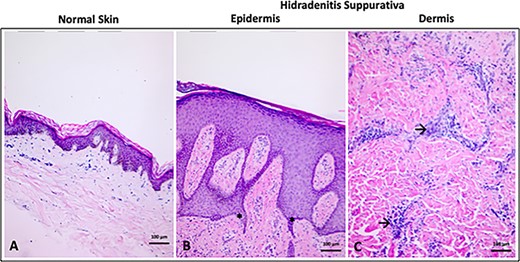 (A) Normal skin epidermis and dermis. (B) Thicker epidermis and increased irregularity of rete ridges (*) in HS. (C) Cellular infiltrate in HS dermis (→). Hematoxylin and eosin stain. Scale bar = 100 μm, 10× magnification.