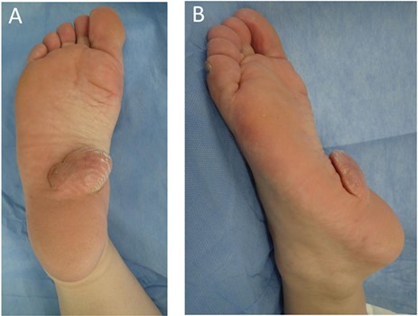 (A) Frontal view of the tumor. (B) Side view of the tumor.