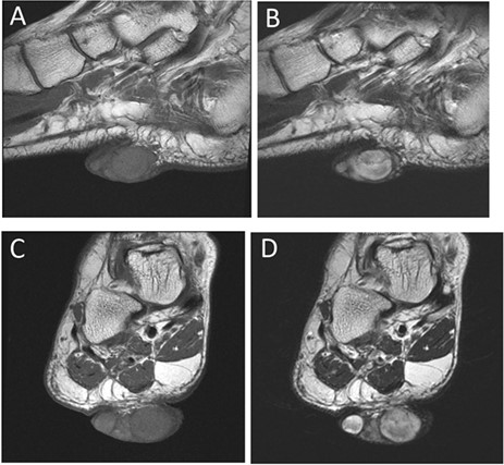 (A) Sagittal view on MRI T1. (B) Sagittal view on MRI T2. (C) Frontal view on MRI T1. (D) Frontal view on MRI T2 (green arrow indicates the tumor).