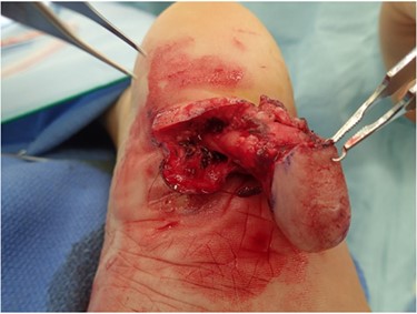 The tumor is seen from the dermis to the subcutaneous fat.