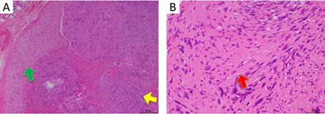 (A) H&E staining at 10× magnification reveals spindle-shaped cells arranged in nuclear palisades, known as Antoni A tissue (indicated by the yellow arrow). A small area was microcystic with a loose meshwork of cells, known as Antoni B tissue (indicated by the green arrow). (B) H&E staining at 40× magnification shows acellular areas located between the regions of nuclear palisading, known as Verocay bodies (indicated by the red arrow).