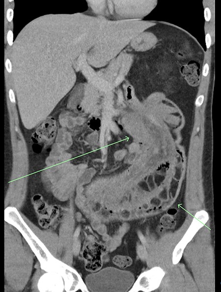 Coronal view of CT imaging demonstrating a very large intussusception on the left side of the abdomen with proximal jejuno-jejunal involvement. Marked enlargement of the intussuscipiens containing the intussusceptum.