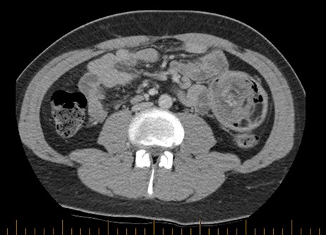 Axial section of CT scan demonstrating a rim of contrast material encircling the intussusceptum, representing coating of the opposing bowel walls of the intussusceptum and intussuscipiens, also referred to as the ‘Target Sign’.