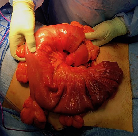 Intraoperative photograph demonstrating distended intussuscipiens with intussuscepted segment of jejunum. Multiple polypoid lesions are evident within the small bowel mesentery.
