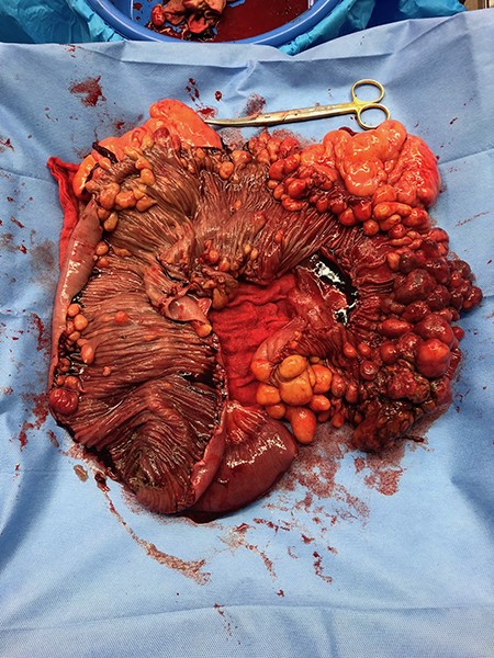 Intraoperative specimen of resected small bowel. Small bowel lumen exposed to show multiple fatty-appearing lesions within small bowel wall.