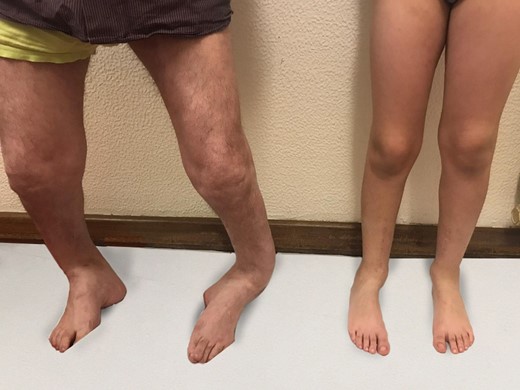 One year after the surgery - the comparison between the father and the child.