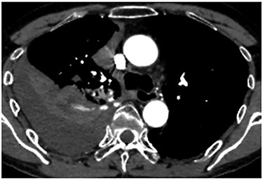 Enhanced chest CT showing an extravasation of contrast media near the fifth thoracic vertebra.